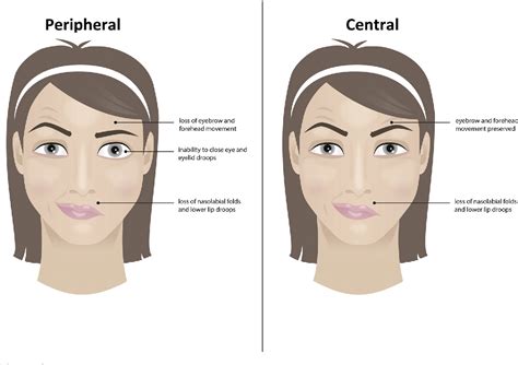 [pdf] Managing Peripheral Facial Palsy Semantic Scholar