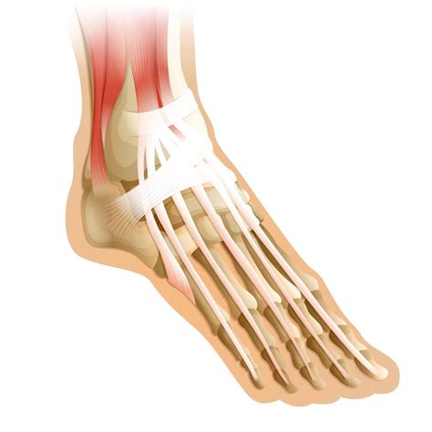 Stress Fractures in Feet