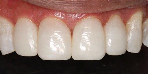 Direct Composite Veneers Vs Porcelain Veneers Clinicians Choice