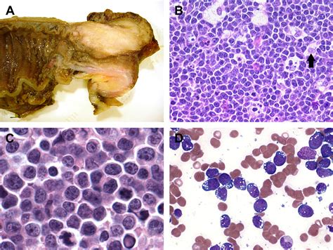 Diffuse Large B Cell Lymphomas And Burkitt Lymphoma Hematology