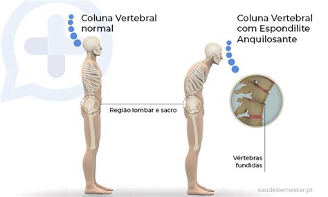 Espondilite Anquilosante É Pcd - Ressonancia Magnetica De Espondilite Anquilosante Ankylosing