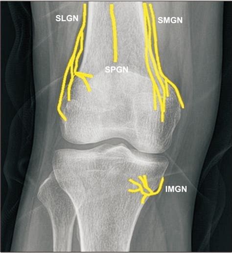 Cooled Radiofrequency Ablation Of Genicular Nerves For Knee Osteoarthritis Abstract Europe Pmc