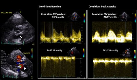 Degenerative Mitral Stenosisdiagnostic Challenges And Future Directions