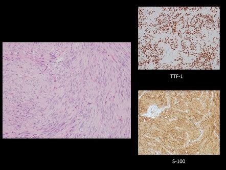 Spindle Cell Oncocytoma Of Pituitary Image Radiopaedia Org