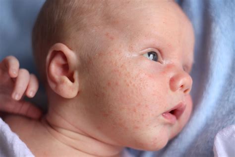 Baby Eczema Vs Acne Symptoms Causes Treatment