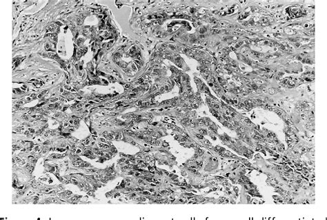 Figure From Malignant Eccrine Spiradenoma A Case Report And Review