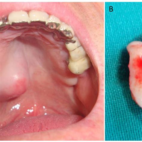 Inflammatory Fibrous Hyperplasia IFH Epulis Fissuratum A