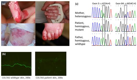 Diagnostics Free Full Text Recessive Dystrophic Epidermolysis