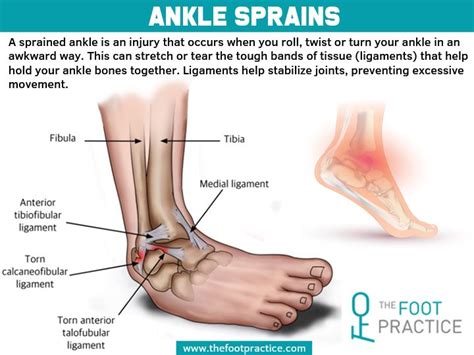 Ankle Sprain Treatment Singapore Artofit