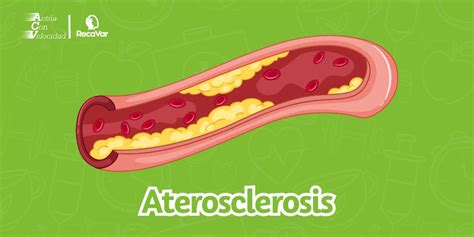 Aterosclerosis Una Enfermedad Que Perjudica Tus Arterias