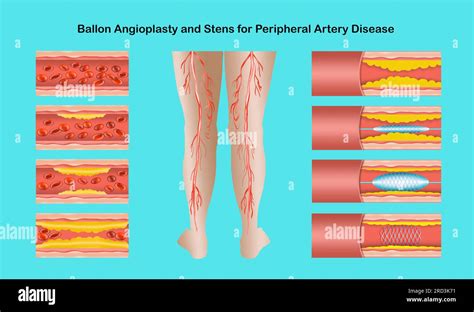 Diagram Showing Angioplasty For Peripheral Artery Disease Illustration