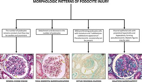 Frontiers | Collapsing Glomerulopathy: A Review by the Collapsing
