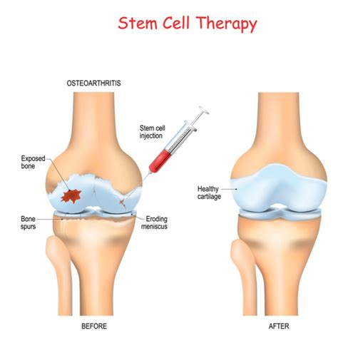 Stem Cell Therapy Houston Spine Regenerative Medicine