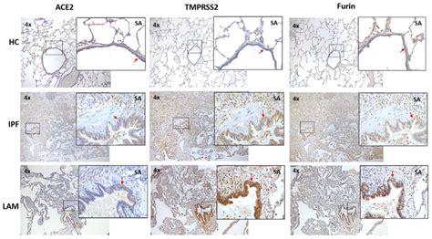 Ace Tmprss And Furin Expression On Small Airway Epithelium And