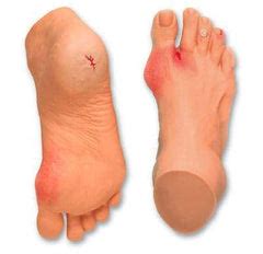 foot wound pathology model ulcer disease byamag buyamag