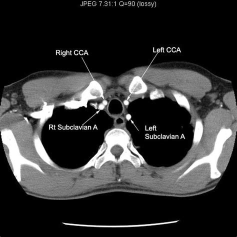 Common Carotid Artery Ct - mapasgmaes