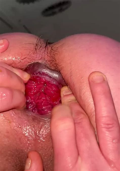 Anal Gape Open Ass Prolapse Gay Amateur Porn Xhamster