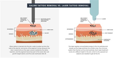 tattoo removal with saline 7