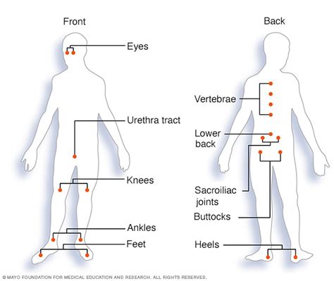 Reactive Arthritis Symptoms Causes Mayo Clinic