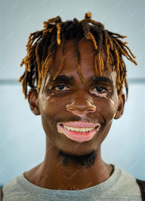 Premium Photo | African american black young man with vitiligo skin