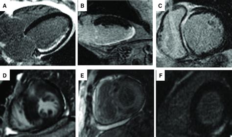 Various Patterns Of Scar By Late Gadolinium Enhancement With Magnetic