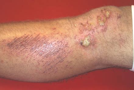 Early Stages Of Mrsa Symptoms