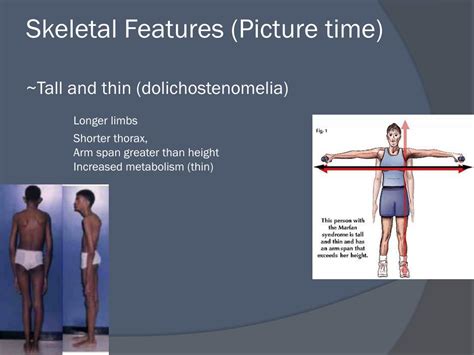 marfan syndrome  powerpoint    id