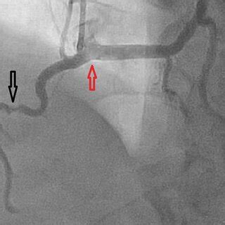 Coronary angiogram showing the left main coronary artery originating ...