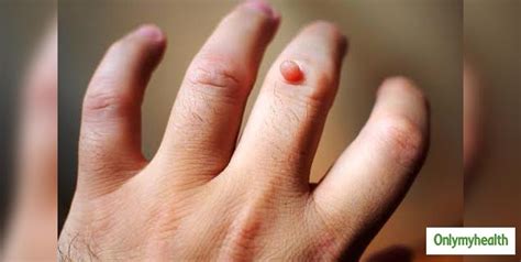 Warts: Symptoms, Causes And Treatment | OnlyMyHealth