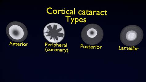 ArtStation - cataract types | Resources