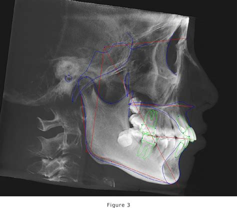 PDF Correlation Between The Size Of The Maxillary Sinus And Vertical