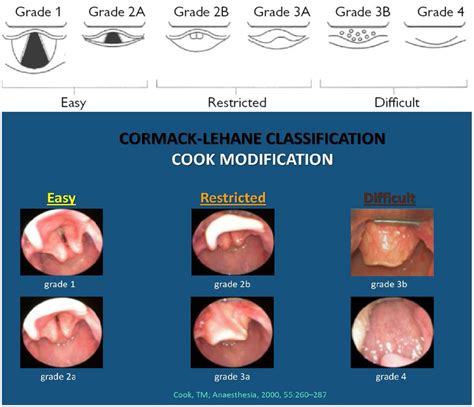 The Modified Cooks Practical Classification Of Laryngeal View The