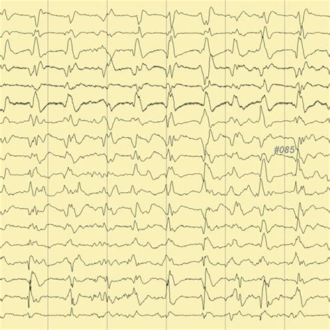 Electroencephalography Showing Suppression Burst Pattern Download