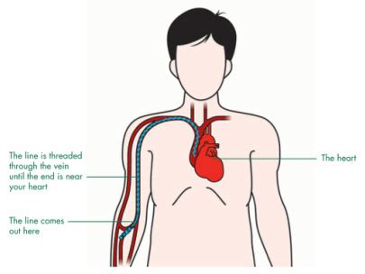 Medicine Notes - Clinical Procedures - Peripheral Line Insertion ...