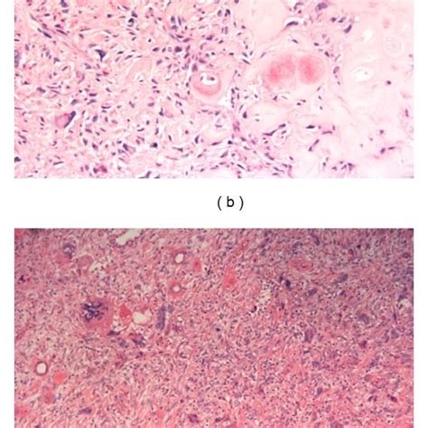 A The Pelvic Resection Specimen Of Dedifferentiated Chondrosarcoma Download Scientific