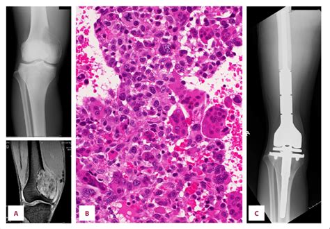 The Plain Radiograph Demonstrates An Ill Defined Osteolytic Lesion