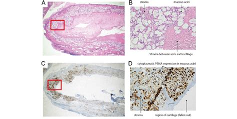 Torus tubarius with overlying gland histology and immunohistochemistry.... | Download Scientific ...