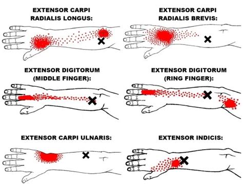 The Definitive Guide to Wrist Extensors Anatomy, Exercises & Rehab in 2024 | Trigger points ...