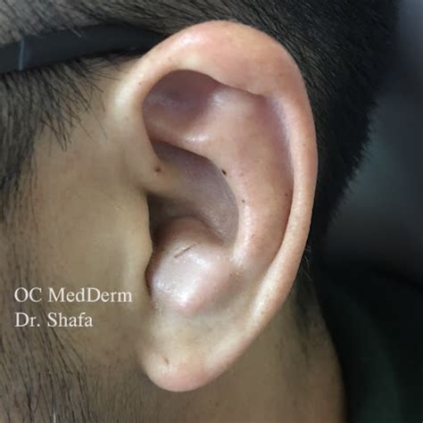 Ear Surgery Irvine Oc Medderm Orange County Dermatology