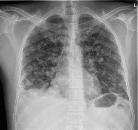 Lung Metastasis Case 002 • LITFL • Lung Ultrasound Library