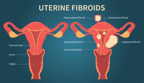 Uterine Fibroid Illustrations Royalty Free Vector Graphics And Clip Art