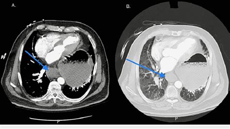 Transverse Section Of Ct Chest Demonstrating A Large Hiatal Hernia And Download Scientific