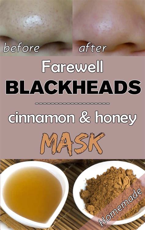 13 Safe Homemade Blackhead Remedies That Work