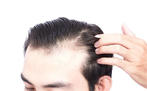 How To Tell If You Have A Receding Hairline