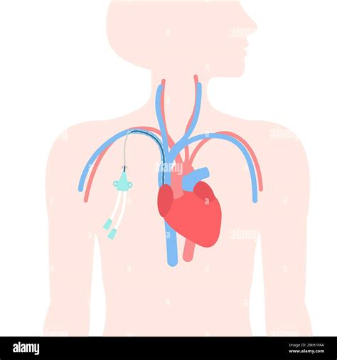 Tunneled Central Line Venous Catheter Medical Diagram Stock Vector