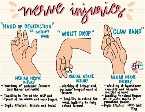 PT flashcards on Twitter: "NERVE INJURIES: Hand of Benediction, Wrist ...