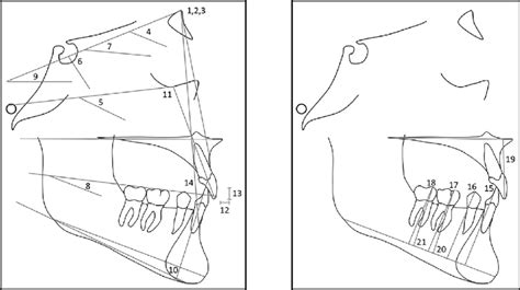 Cephalometric Measurements 1 Sna 2 Snb 3 Anb 4 Sn Gogn 5 Download Scientific