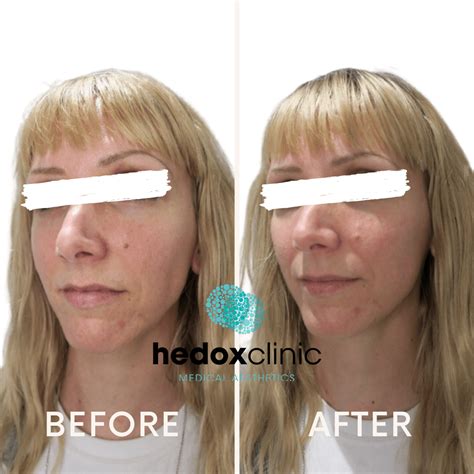 Sunken Cheeks Treatment London Hedox Clinic