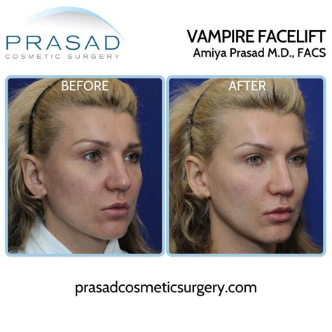 Vampire Facelift Quick Facial Rejuvenation New York