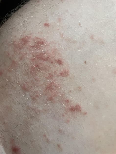 Post Scabies Aftermath Rscabies